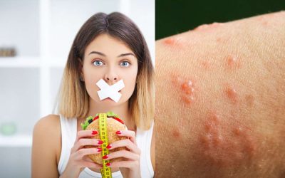 Jenis Makanan yang Dilarang untuk Penyakit Herpes Zoster