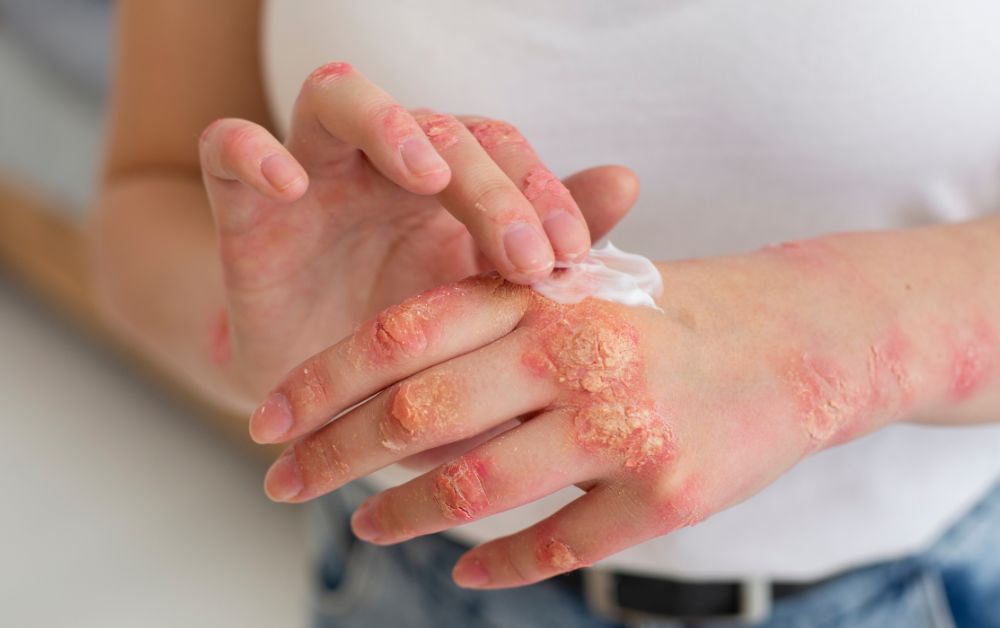gejala psoriasis