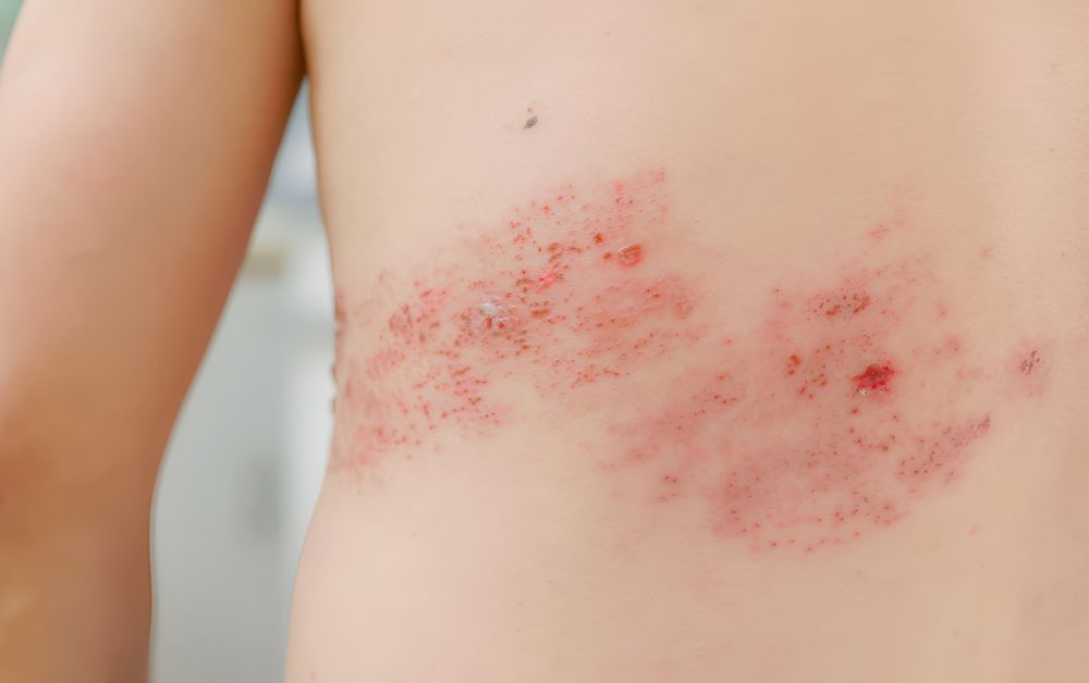 seorang pria mengalami herpes zoster Postherpetic Neuralgia: Komplikasi Tersembunyi Herpes Zoster